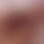 lentigo of the mucosa. incident light microscopy: brown to greyish-brown pigment streaks and pigm...