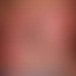 Lentigo of the mucous membrane; for more than 1 year existing, about 2 cm in diameter, irregular ...