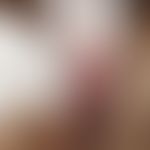 Lentigo of the mucosa: for 10 years persistent, irregular, blurred, brown-black spots in the area...