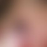 Lentigo of the mucous membrane. 10 years of persistent, irregular, blurred, brown-black macular i...