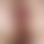 Chronic stationary, perianal localized, asymmetrical, blurred, brown-black, smooth patches. 