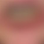 Congenital (familial) lentiginosis of red lips, lip and oral mucosa, especially Peutz-Jeghers syn...