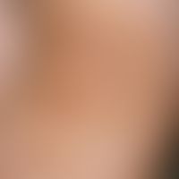 Becker nevus: planar and spatter-like hyperpigmentation, focal hypertrichosis in the region of th...
