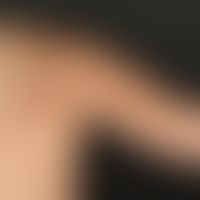 Becker nevus: General view: Approx. 20 x 26 cm measuring, homogeneously pigmented, hairless, mela...