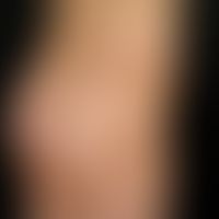 Becker-Naevus: Since birth existing, extensive hyperpigmentation in the area of the right hip in ...