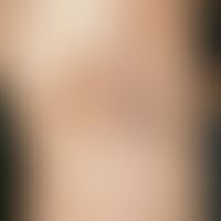 Becker-Naevus: chronically stationary, planar, splatter-like light brown pigmented, rough, sharpl...