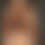 Melanosis neurocutanea: General view: Huge melanocytic nevus occupying nearly the whole trunk in ...