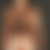 Melanosis neurocutanea: General view: Huge melanocytic nevus occupying nearly the whole trunk in ...