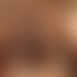 Melanosis neurocutanea, general view: Huge, hairy, melanocytic nevus occupying almost the entire ...