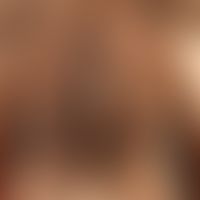 Melanosis neurocutanea. Übersichtsaufnahme: Riesiger, nahezu den gesamten Rumpf einnehmender, beh...