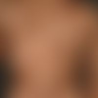 Melanosis neurocutanea. general view: Huge melanocytic nevus occupying nearly the whole back with...