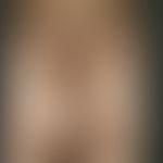 Melanosis neurocutanea. Multiple congenital melanocytic giant nevi. Blotchy pattern with no midli...