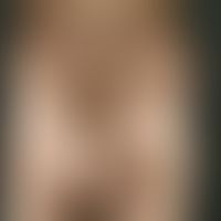 Melanosis neurocutanea. Multiple congenital melanocytic giant nevi. Blotchy pattern with no midli...