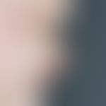 Melkersson-Rosenthal syndrome: Solid doughy swelling of the upper lip, initially recurrent, now p...