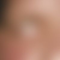 Melkersson-Rosenthal syndrome. Unilateral facial nerve palsy in a 26-year-old patient.