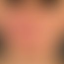 Melkersson-Rosenthal-Syndrom:&nbsp;persistierende, einseitige, gerötete, feste, Gesichtschwellung...