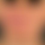 Melkersson-Rosenthal syndrome. persistent unilateral reddened facial swelling in the area of the ...
