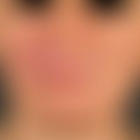 Melkersson-Rosenthal-Syndrom:&nbsp;persistierende, einseitige, gerötete, feste, Gesichtschwellung...