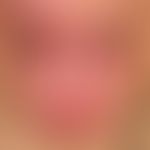 Melkersson-Rosenthal syndrome. distinct erythema with doughy swelling in the region of the upper ...