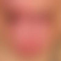 Melkersson-Rosenthal syndrome. distinct erythema with doughy swelling in the region of the upper ...