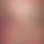 Melkersson-Rosenthal syndrome. 55-year-old female patient has a unilateral swelling of the entire...