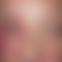 Melkersson-Rosenthal-Syndrom. Bei der 55-jährigen Patientin besteht eine einseitige Schwellung de...