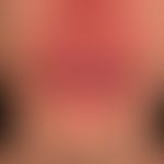 Melkersson-Rosenthal syndrome, monosymptomatic form of the disease with the most severe, complete...