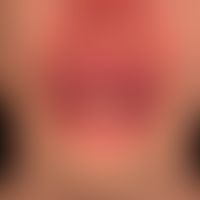 Melkersson-Rosenthal-Syndrom: monosymptomatische Verlaufsform mit schwerster, vollständig therapi...