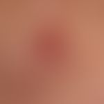 Merkelzell-Karzinom: typischer glatter roter (pigmentfreier) schmerzloser, fester&nbsp;Knoten mit...