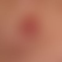 Merkel cell carcinoma: typical smooth red (pigment-free) painless, firm lump with a calotte-shape...