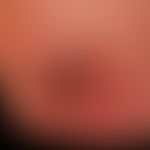 Merkel-Zell-Karzinom:&nbsp;Jetzt uncharakteristischer ulzerierter, plattenartiger Knoten. Zuvor k...