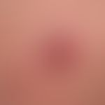 Merkelzell-Karzinom:&nbsp; ungewöhnliches&nbsp;plattenartiges Wachstum.&nbsp;
