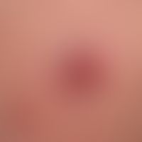 Merkel cell carcinoma: unusual plate-like growth.
