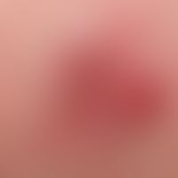 Merkel cell carcinoma,close-up.
