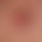 Merkelzell-Karzinom.&nbsp;Wenig charakteristischer gefelderter oberflächenglatter, völlig symptom...