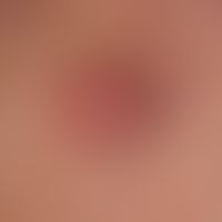 Merkel cell carcinoma, a lesscharacteristically fielded, surface smooth, completely asymptomatic ...