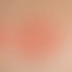 Microspore. detailed picture with anular plaque, marginal scaling ruffle with central pallor (tru...
