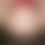 microspores. acute, since 3 weeks existing, constantly multiplying, slightly itchy, rough spots a...