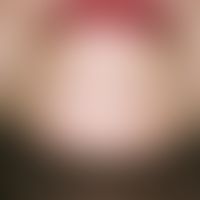microspores. acute, since 3 weeks existing, constantly multiplying, slightly itchy, rough spots a...
