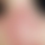 Microspore: multicenter, acute, since 4 weeks existing, increasing, initially 0.2-0.3 cm large, l...