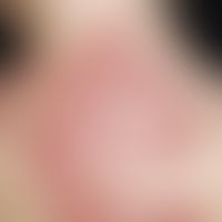 Microspore: multicenter, acute, since 4 weeks existing, increasing, initially 0.2-0.3 cm large, l...