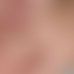 Secondarymilia in an underlying disease with blister formation: Pinhead-sized, spherical, yellowi...
