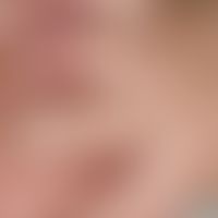 Secondarymilia in an underlying disease with blister formation: Pinhead-sized, spherical, yellowi...