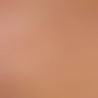 Detail enlargement: Solitarymilieu at the décolleté of a 78-year-old patient with several telangi...