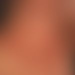 Mixed connective tissue disease: sattrote unscharf begrenzte, poikilodermatische Flecken und Plaq...