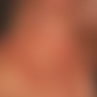Mixed connective tissue disease: sattrote unscharf begrenzte, poikilodermatische Flecken und Plaq...