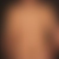 Mixed connective tissue disease. generalized extensive poicilodermal spots. painful swelling of t...