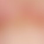 Mixed connective tissue disease.&nbsp;Detailaufnahme. Hyperkeratotischer Nagelfalz mit elongierte...