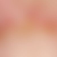 Mixed connective tissue disease, detailed picture of hyperkeratotic nail fold with elongated capi...