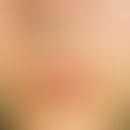 MMN-Syndrom. Knötchen- und plattenartige, derbe Tumorbildung an Oberlippe und Nase.